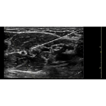 ultrasound image of a nerve block of the axillary nerve using the 12L-RS ultrasound transducer