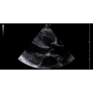 ultrasound image of a Cardiac, ASD using the 12S-RS ultrasound transducer