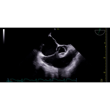 ultrasound image of a transesophageal echocardiogram (TEE) using the 6Tc-RS ultrasound transducer