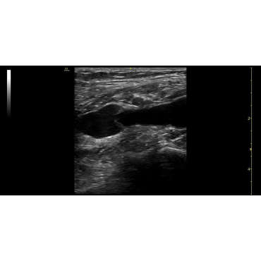ultrasound image of the Popliteal Vein using the 9L-RS ultrasound transducer