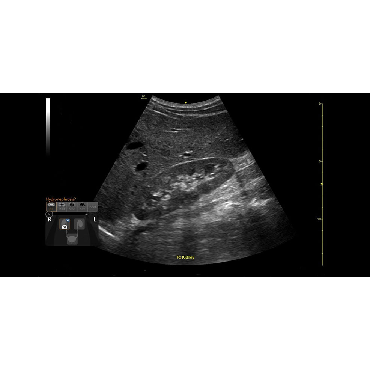 Curved (Convex) ultrasound image using eFast and the C1-5-RS ultrasound transducer