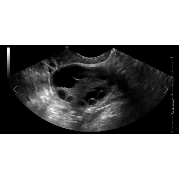 ultrasound image of an ovary using the E8C-RS ultrasound transducer