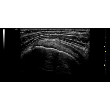 ultrasound image of the brachial plexus using the L4-12t-RS ultrasound transducer