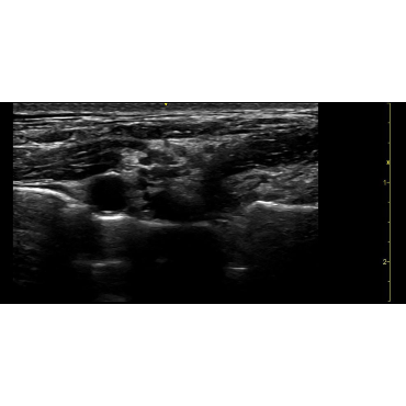 ultrasound image of the brachial plexus using the L4-20t-RS ultrasound transducer