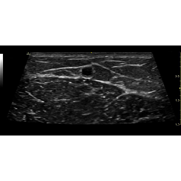ultrasound image showing Vascular Access of the Cephalic vein using the L8-18i-RS ultrasound transducer