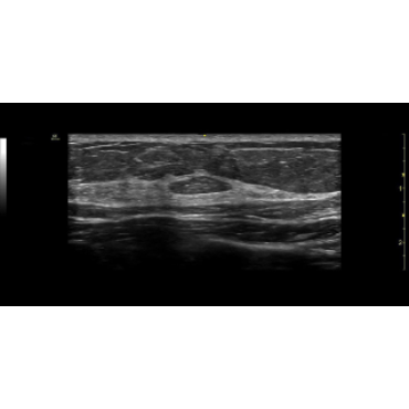 ultrasound image of the Popliteal Vein using the ML6-15-RS ultrasound transducer
